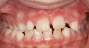 Before Phase 1 Treatment
